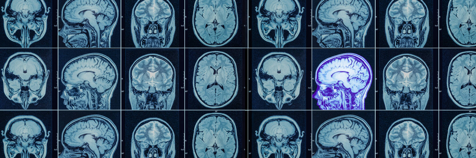 Image shows a number of brain scans with one highlighted in violet. 
