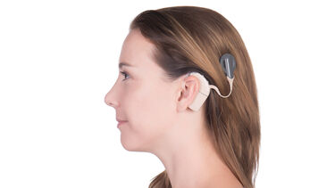 Cochlear implant
