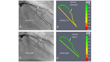 Diagrams depicting Virtual Coronary Intervention.