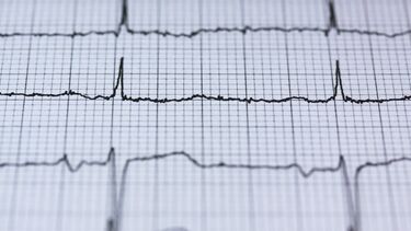 A photograph of an electrocardiogram showing a normal heart rate.