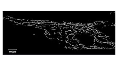 A fibroblast from a patient with Parkinson’s Disease 