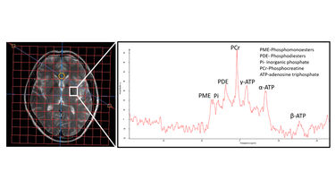 MR Spectroscopy of a human brain