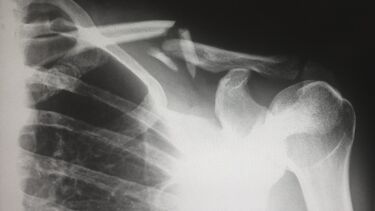 X-ray of shoulder joint