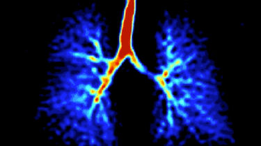 Image of lungs