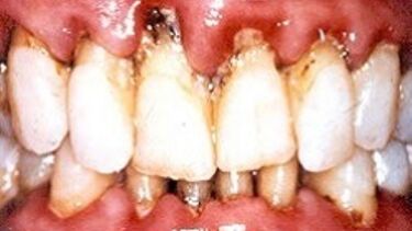 Example of periodontitis
