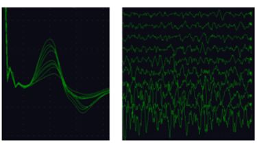 Compound muscle action potentials, surface EMG recordings