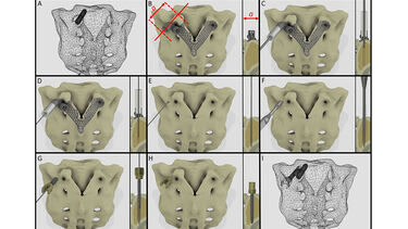 Figure: Proposed surgical technique for safe and accurate screw insertion in convergent position.