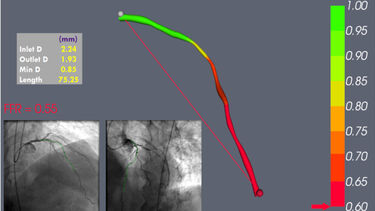 Virtual Fractional flow reserve