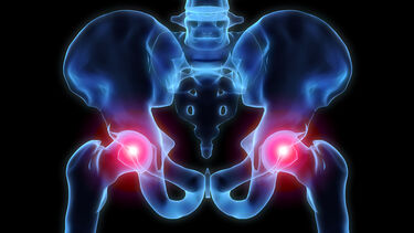 Hip joint x-ray graphic