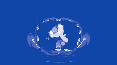Stylised CT image showing the great vessels