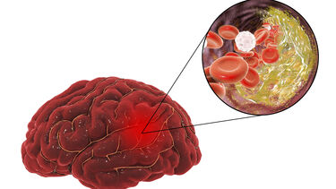 atherosclerosis in brain