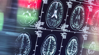 A photo of several brain scans