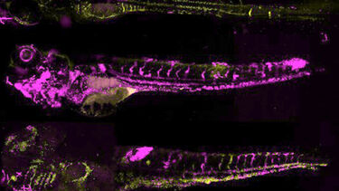 A brain scan showing infected brain blood vessels with spread of infection into the brain