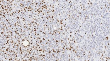 Ki-67 - Immunohistochemistry