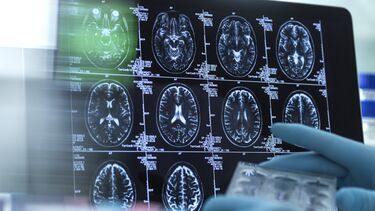 An image of a brain scan on a screen.