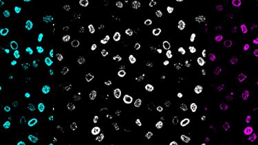 Typhoid Fever cells