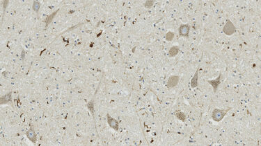 Immune cell marker in MND spinal cord, Robin Highley