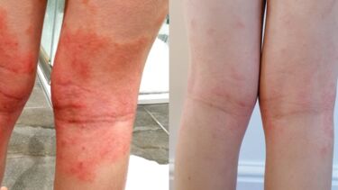 side-by-side photos of a child's legs showing the effects of eczema medication