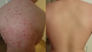 side-by-side photos of a child's back showing the effects of eczema medication