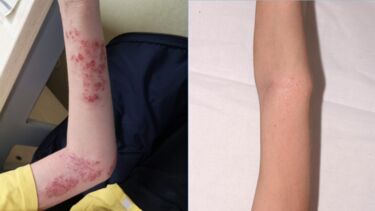 Side-by-side photos of a child's arm showing the effects of eczema medication