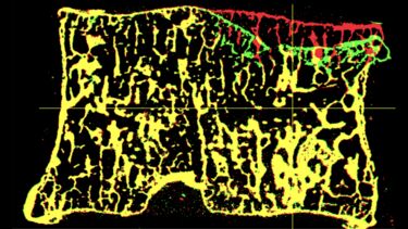 Scan of a human vertebra showing local deformation