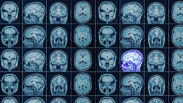 Image shows a number of brain scans with one highlighted in violet. 