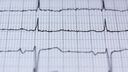 A photograph of an electrocardiogram showing a normal heart rate.