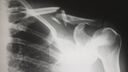 X-ray of shoulder joint