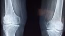 X-ray of knee bones