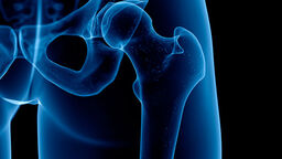 Hip xray osteoporosis
