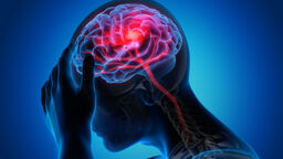 Medical illustration of a brain with stroke symptoms