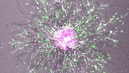 Microscopic image of ovarian cancer cells