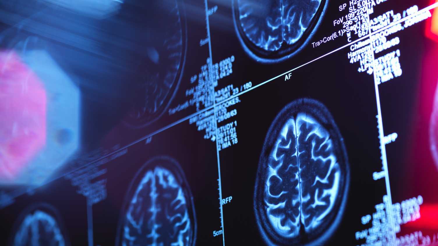 Thumbnail for Crossing the blood brain barrier - imaging human brain perfusion with hyperpolar…
