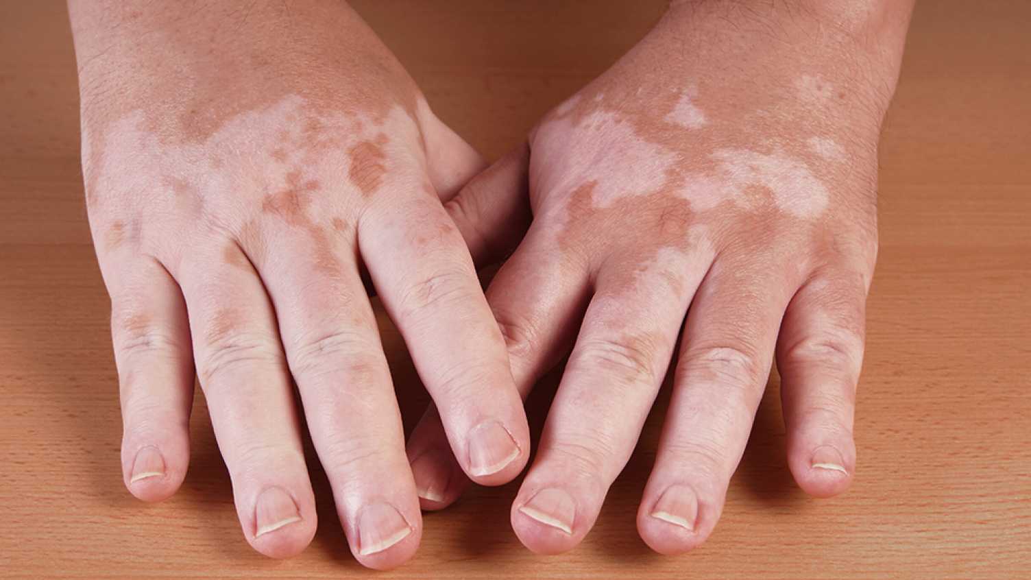 Thumbnail for Psychosocial stress associated with skin conditions | Research 