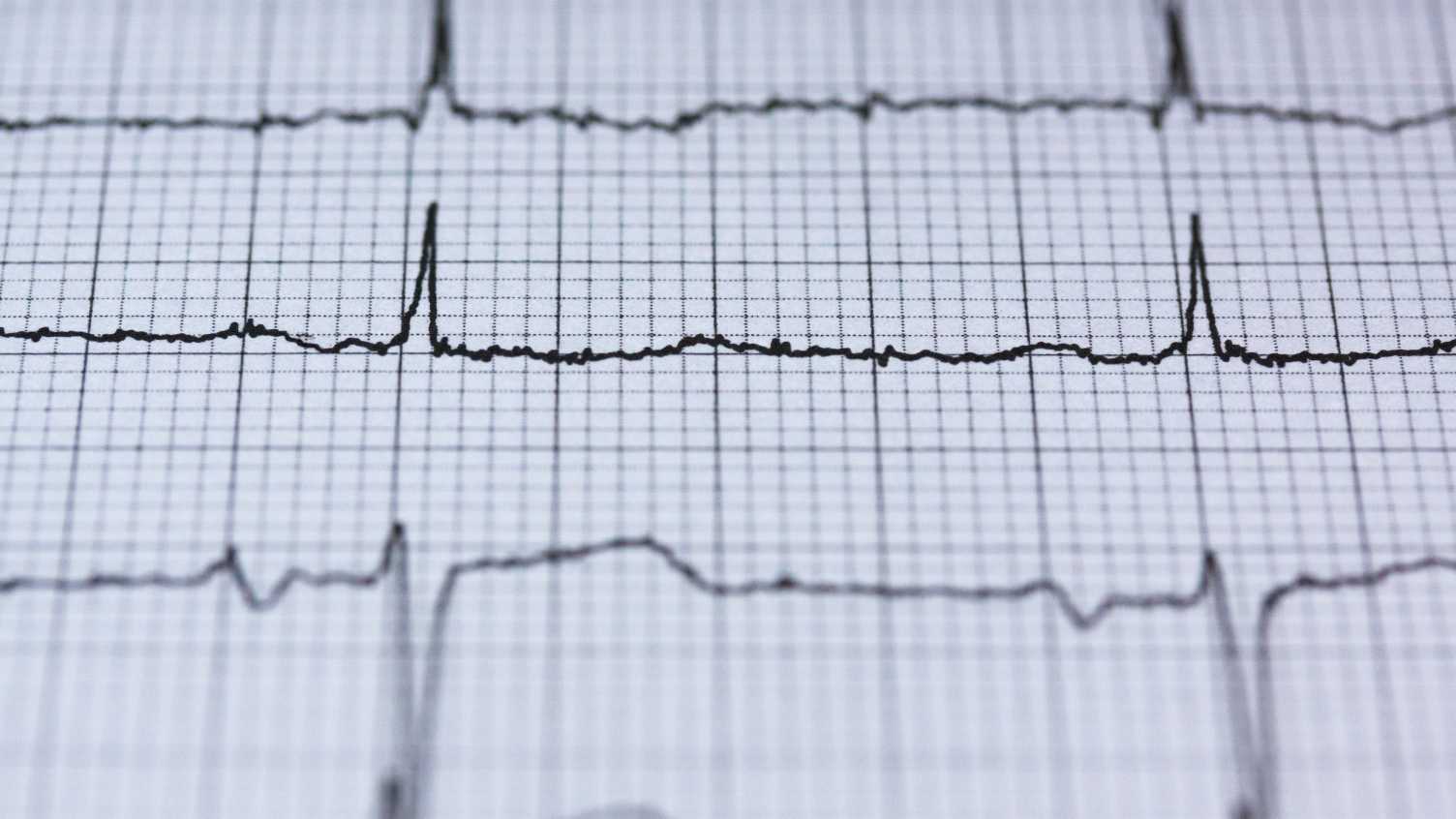 Thumbnail for New marker could help to identify heart attack patients most at risk | Medicine …