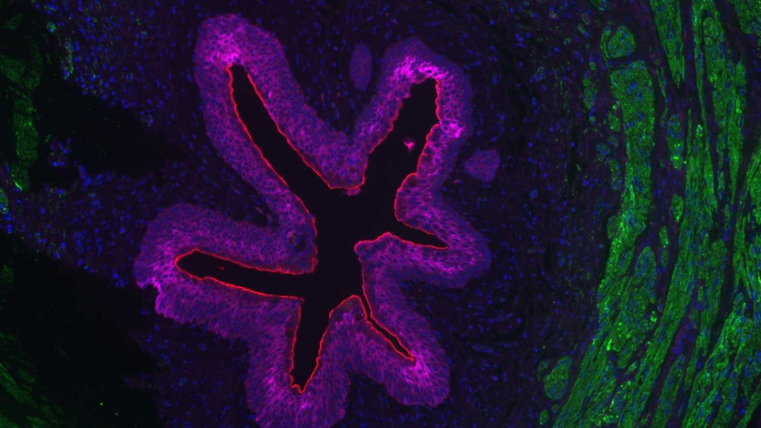 Thumbnail for Cancer | Medicine and Population Health 