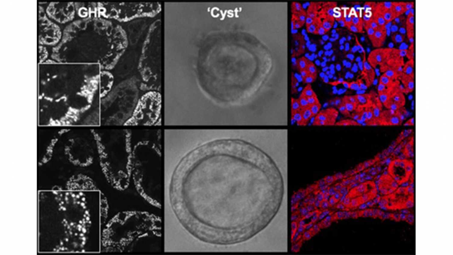 Thumbnail for Growth hormone contributes to polycystic kidney disease | Medicine and Populatio…