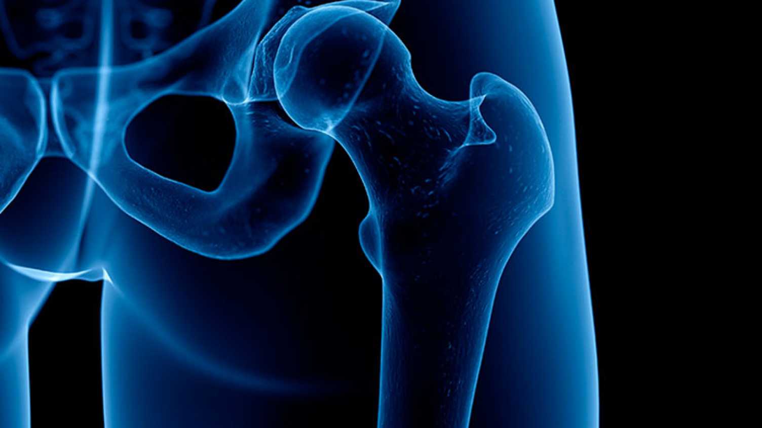 Thumbnail for Osteoporosis in men overlooked by doctors and patients | News 