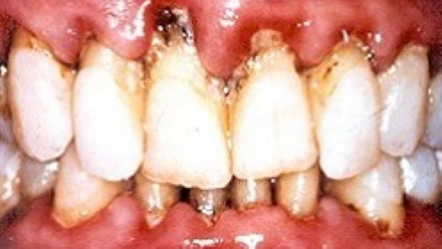 Thumbnail for Interleukin-1 gene biomarkers revolutionise personalised dental healthcare in th…