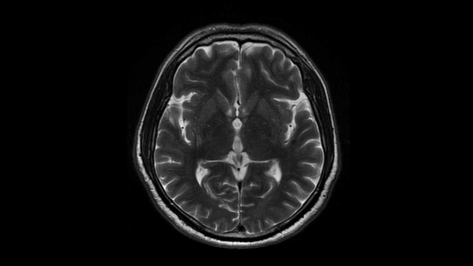 Thumbnail for Imaging technique proves effective in measuring mitochondrial dysfunction in mot…