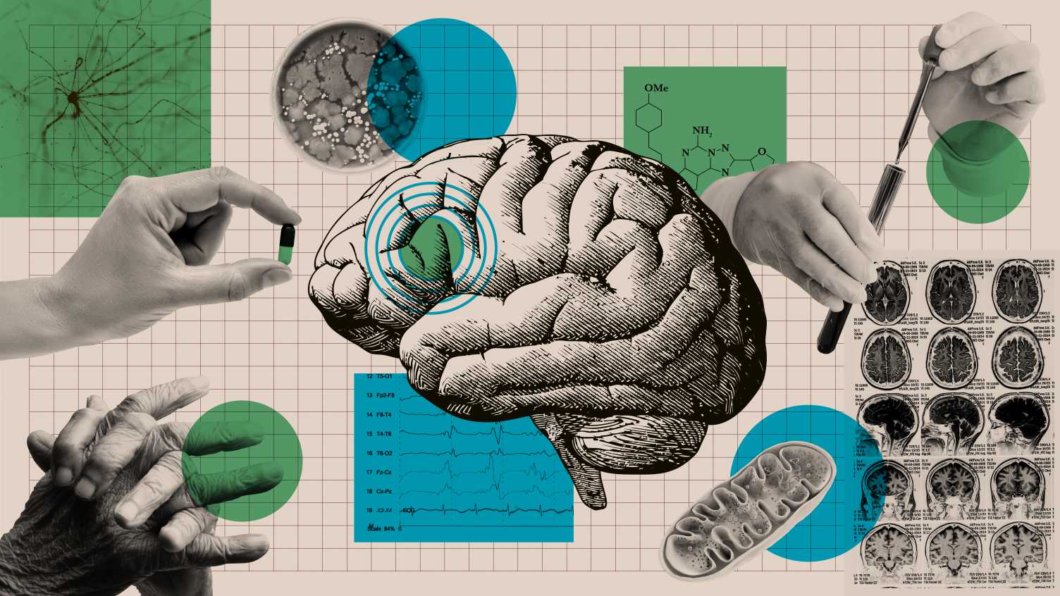 Thumbnail for Sheffield scientists awarded £1.2 million to design Parkinson’s drug | Neuros…