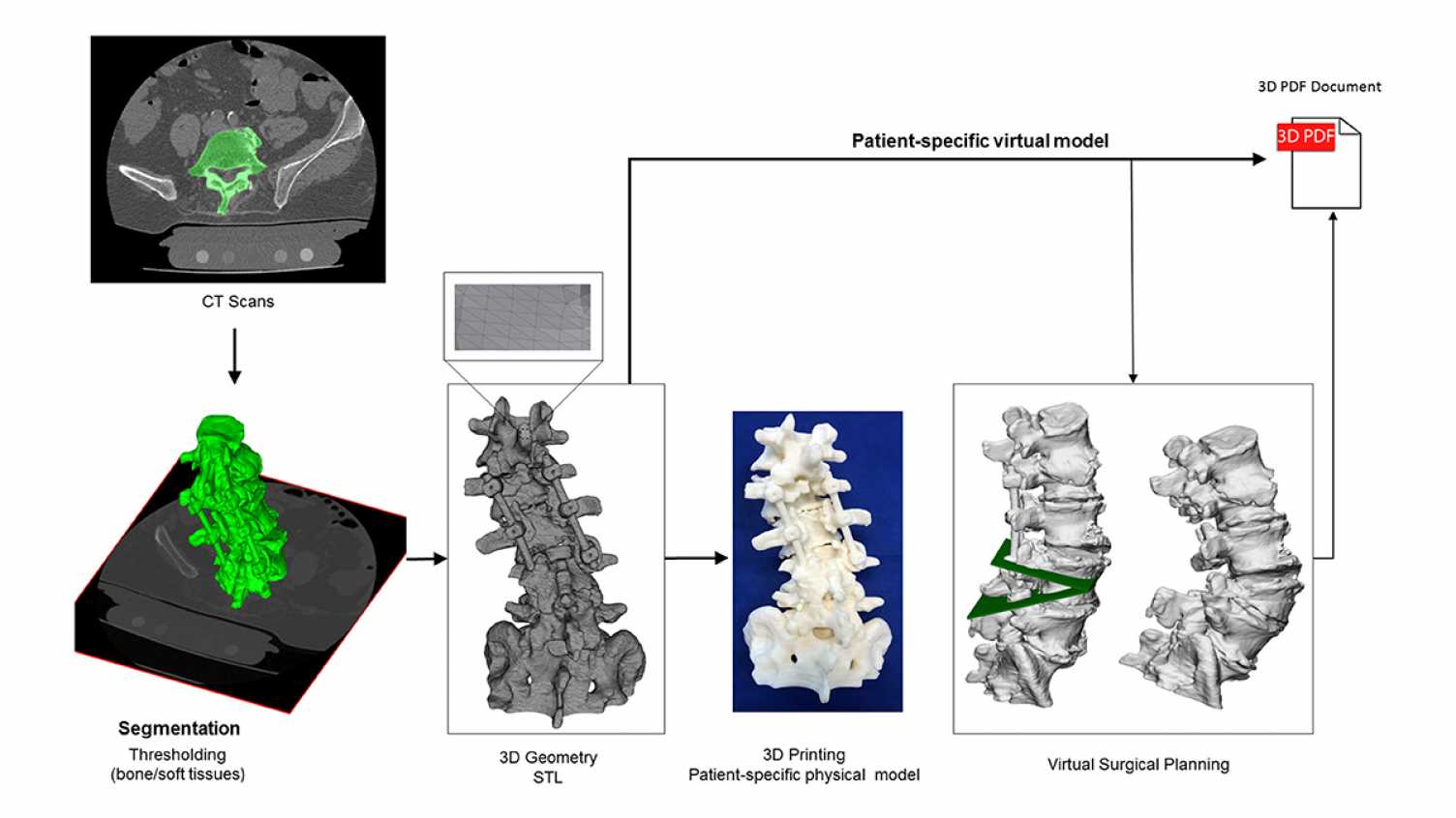 Thumbnail for Complicated postoperative flat back deformity correction | Spinner-EID 