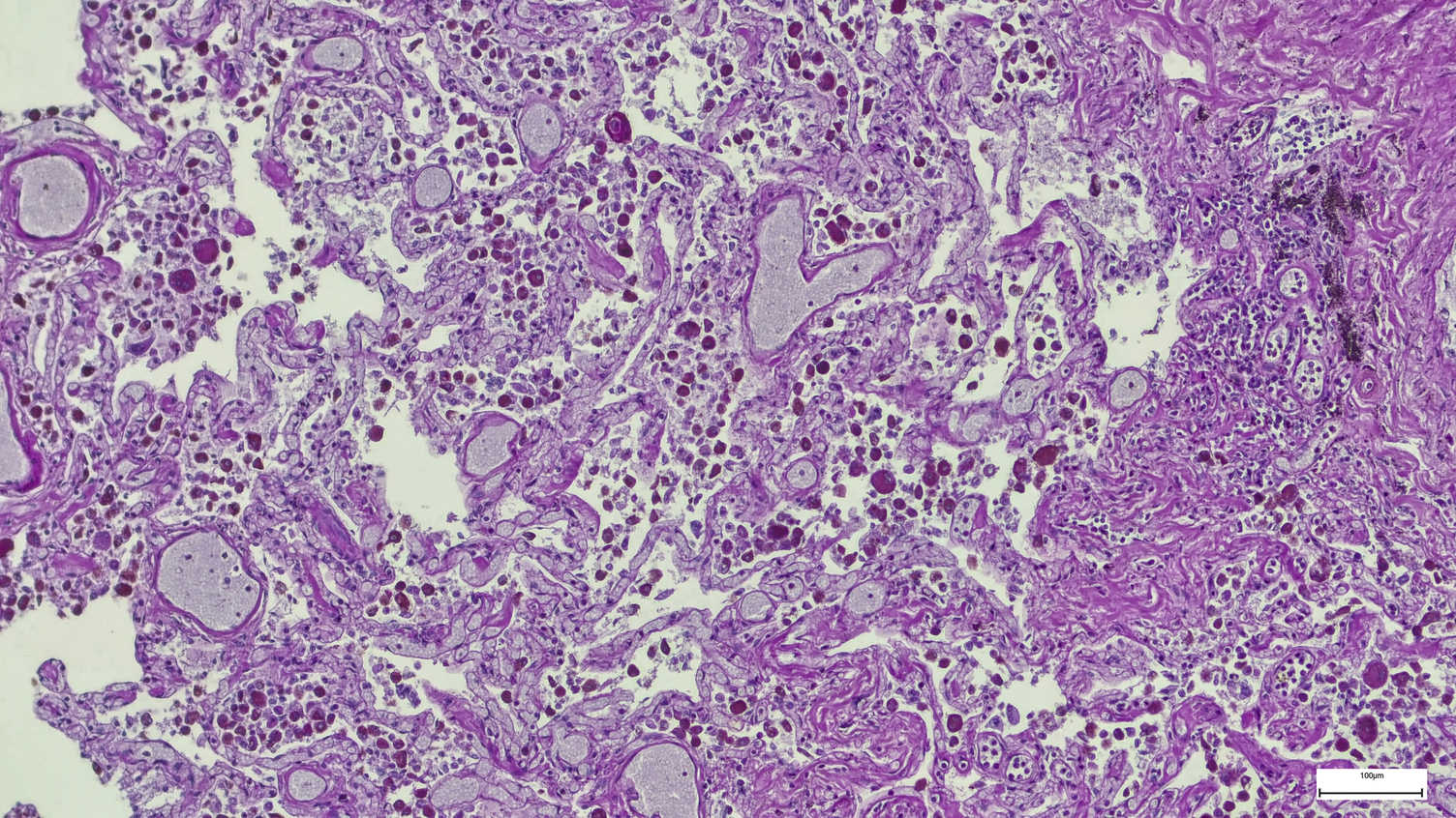 Thumbnail for Energy-starved breast cancer cells consume their surroundings for fuel | News 