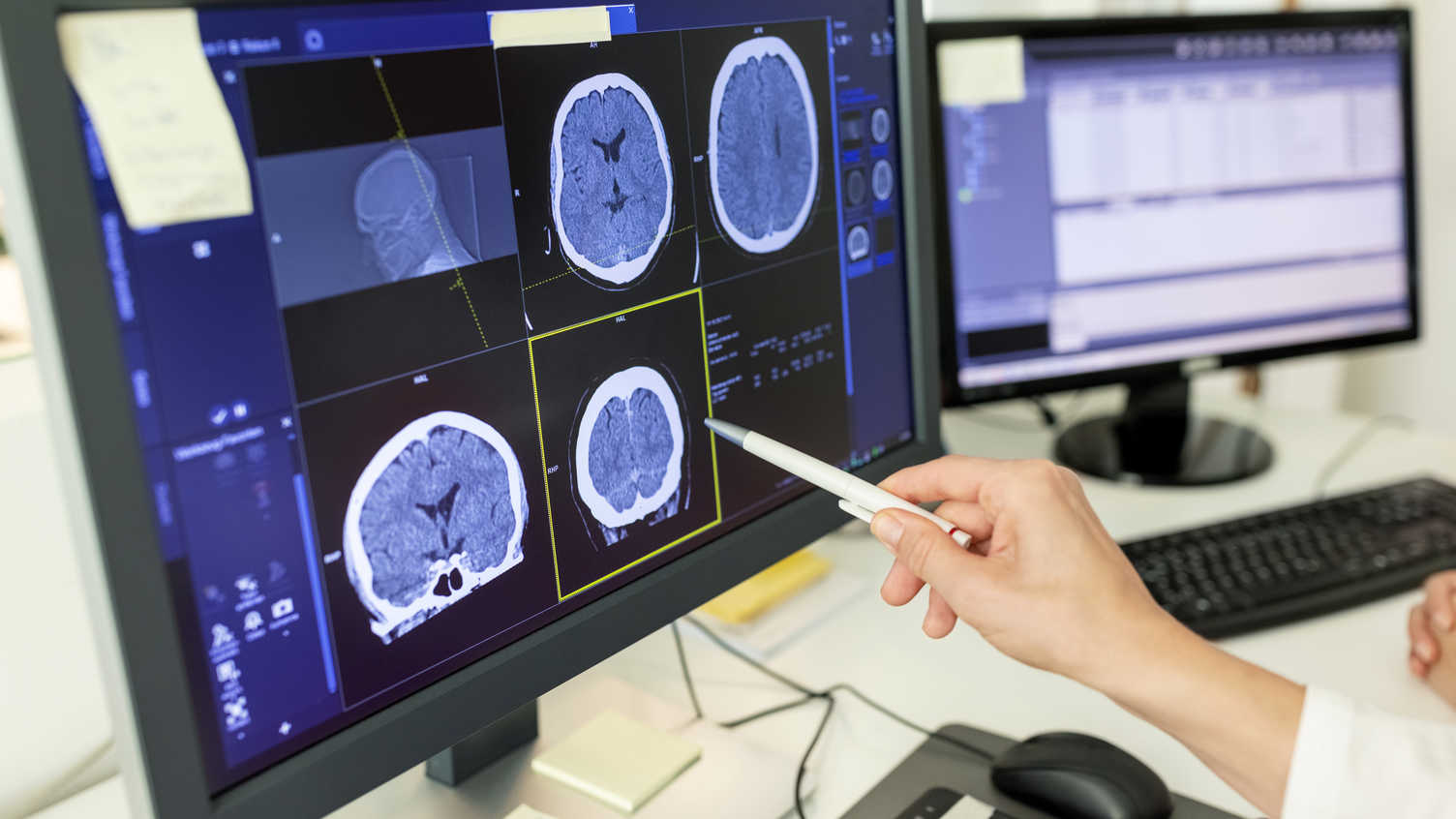 Thumbnail for New guidance approves AI-derived software for stroke assessments | Neuroscience …