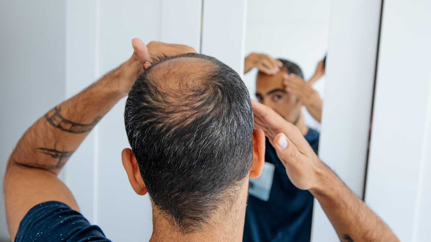 Thumbnail for 2dDR for Hair Growth | Commercialisation 